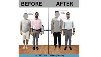 Painful yet effective way to add few more inches to your height through Limb Lengthening in India